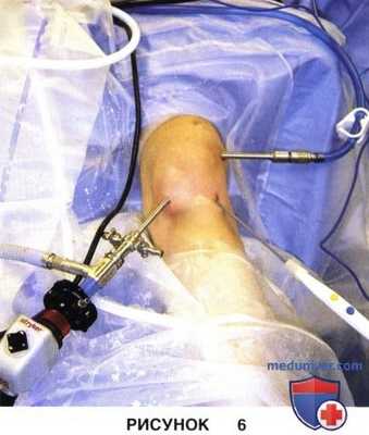 Доступ, техника артроскопического релиза и удлинения латерального удерживателя надколенника