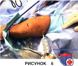 Доступ и техника артроскопического артролиза коленного сустава