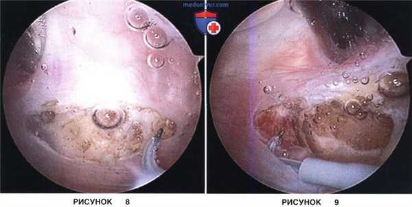 Доступ, техника артроскопического релиза и удлинения латерального удерживателя надколенника