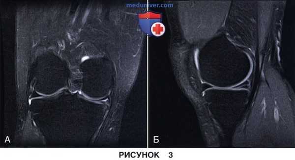 Показания и подготовка к артроскопической менискэктомии коленного сустава