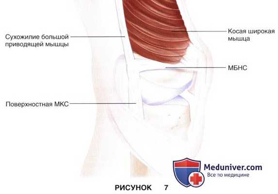 Показания, подготовка к восстановлению медиальной бедренно-надколенниковой связки при свежем вывихе надколенника