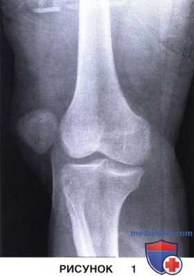 Показания, подготовка к восстановлению медиальной бедренно-надколенниковой связки при свежем вывихе надколенника