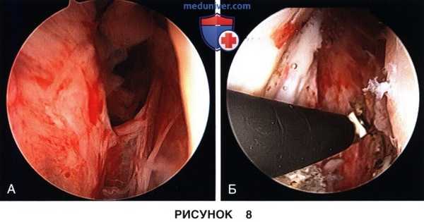 Доступ и техника артроскопического артролиза коленного сустава