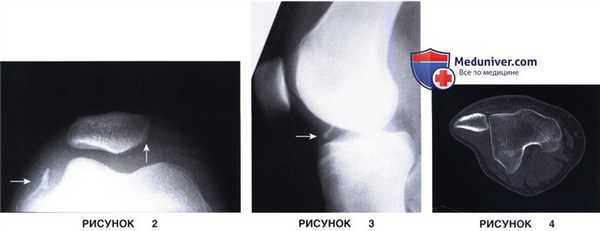 Показания, подготовка к восстановлению медиальной бедренно-надколенниковой связки при свежем вывихе надколенника