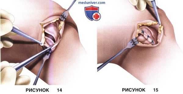 Доступ, техника артроскопического релиза и удлинения латерального удерживателя надколенника