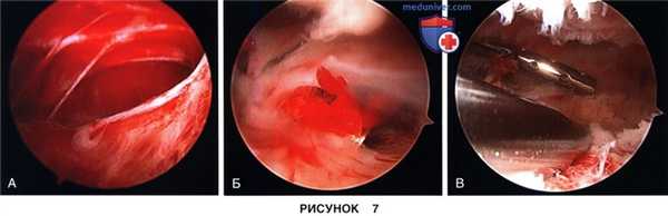 Доступ и техника артроскопического артролиза коленного сустава