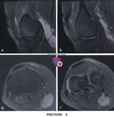 Показания и подготовка к артроскопической менискэктомии коленного сустава