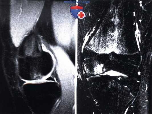 Показания и подготовка к остеохондральной аутотрансплантации коленного сустава