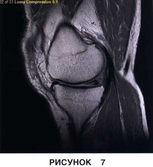 Показания и подготовка к артроскопической менискэктомии коленного сустава