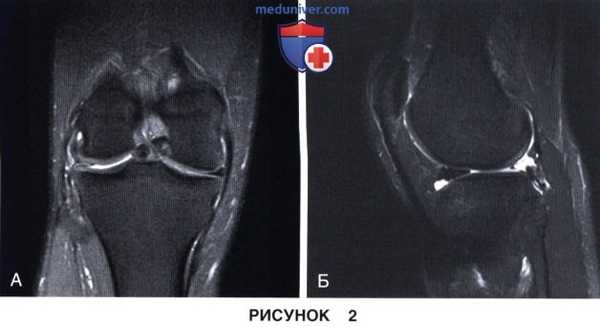 Показания и подготовка к артроскопической аллотрансплантации мениска коленного сустава