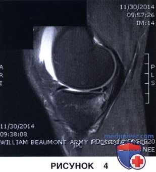 Показания и подготовка к артроскопической менискэктомии коленного сустава