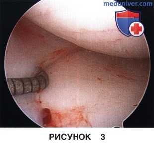 Показания и подготовка к артроскопической аллотрансплантации мениска коленного сустава