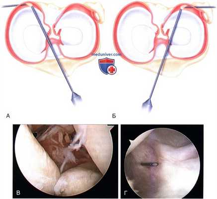 Доступ и техника артроскопической синовэктомии коленного сустава