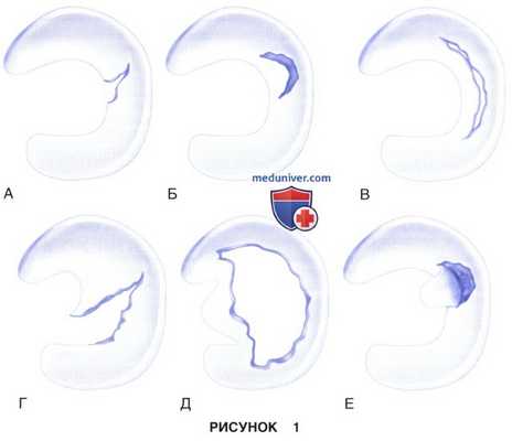 Показания и подготовка к артроскопической менискэктомии коленного сустава