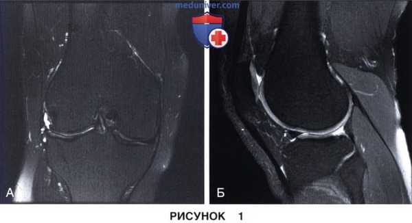 Показания и подготовка к артроскопической аллотрансплантации мениска коленного сустава