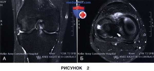 Показания и подготовка к артроскопической менискэктомии коленного сустава