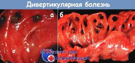 Дивертикулярная болезнь толстой кишки