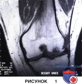Показания и подготовка к имплантации аутологичных хондроцитов в коленный сустав