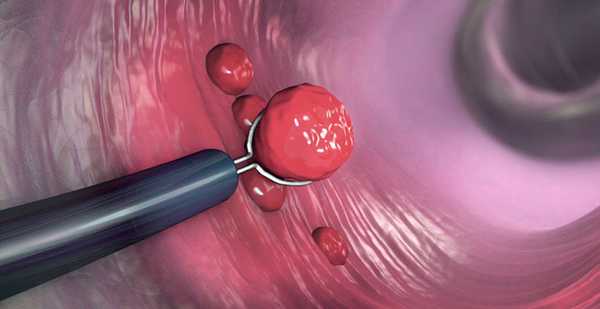 Удаление кишечного полипа во время колоноскопии