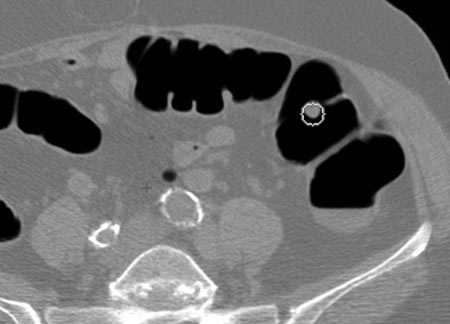 Снимок, выполненный во время КТ-колонографии