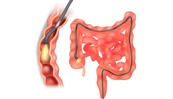 Колоноскопия, схема