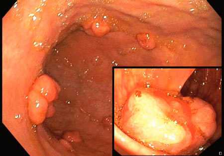 Кишечные полипы, обнаруженные во время колоноскопии