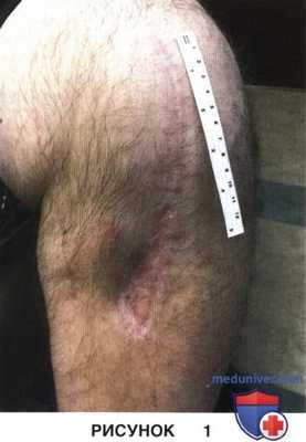 Показания, подготовка к тотальному эндопротезированию коленного сустава