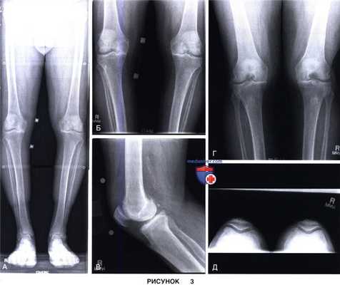 Показания, подготовка к тотальному эндопротезированию коленного сустава