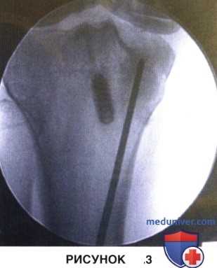 Доступ, техника субхондропластики коленного сустава