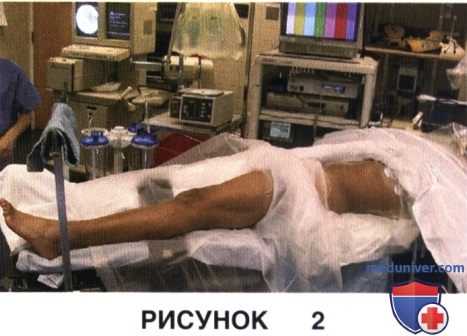 Показания и подготовка к открытой клиновидной высокой тибиальной остеотомии коленного сустава