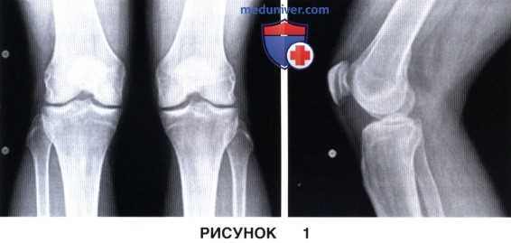 Показания и подготовка к субхондропластике коленного сустава