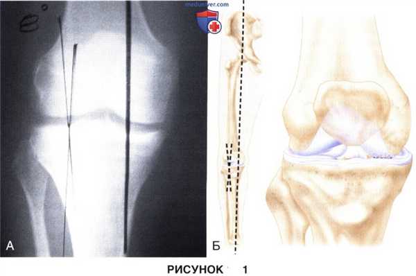 Показания и подготовка к открытой клиновидной высокой тибиальной остеотомии коленного сустава
