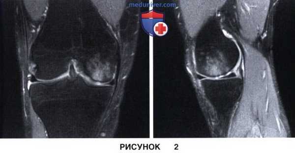 Показания и подготовка к субхондропластике коленного сустава
