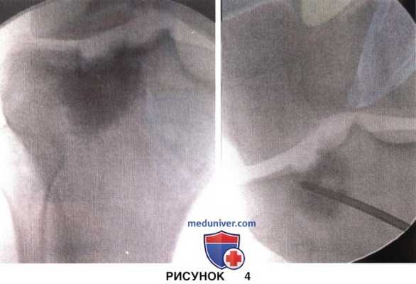 Доступ, техника субхондропластики коленного сустава