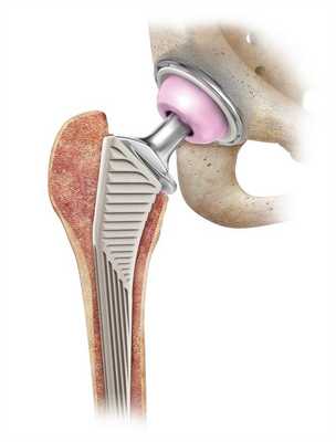 Эндопротезирование при остеомиелите кости