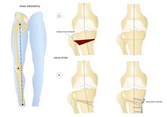 Остеотомия коленного сустава: визуальное изображение процедуры