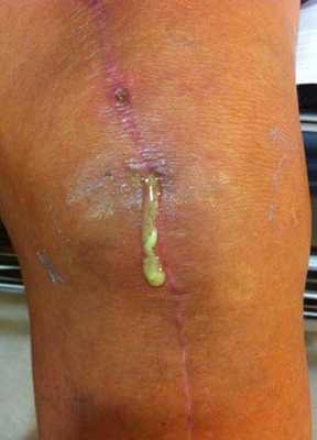 инфекция протеза