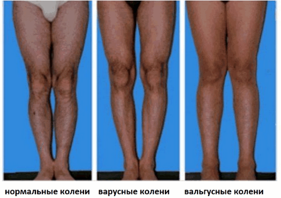 Показания для корригирующей остеотомии