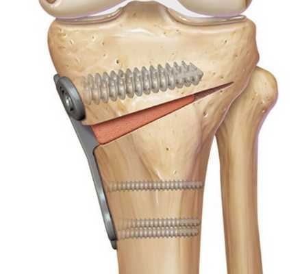 Корригирующая остеотомия коленного сустава