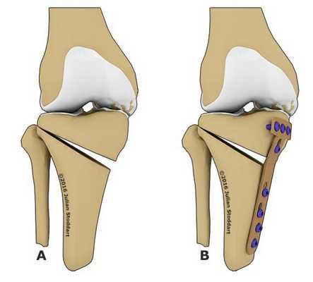 Как проходит операция корригирующей остеотомии