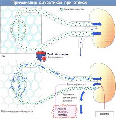 Применение диуретиков при отеках