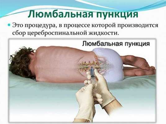 Что такое люмбальная пункция