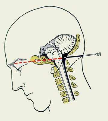 пункция головного мозга