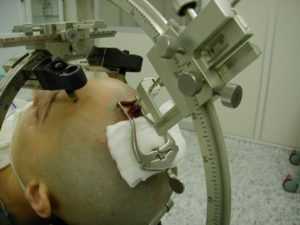 Взятие ликвора для диагностики