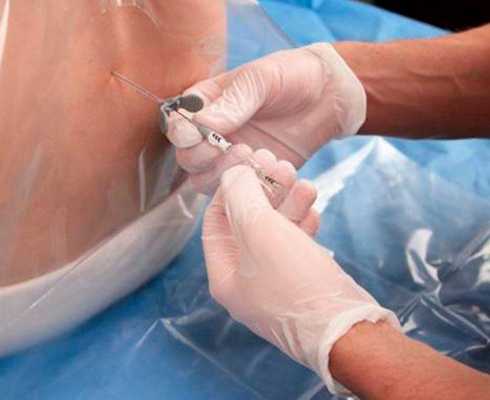 Пункция спинного мозга