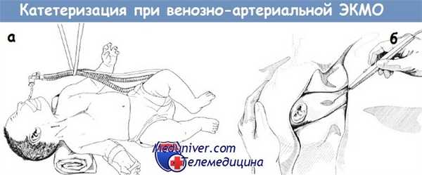 Катетеризация для венозно-артериальной ЭКМО