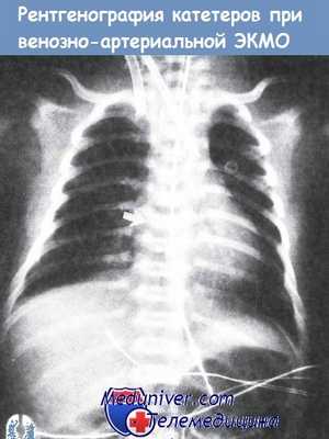Рентгенография катетеров при венозно-артериальной ЭКМО