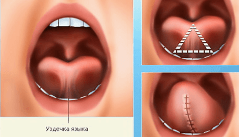 Пластика уздечки языка