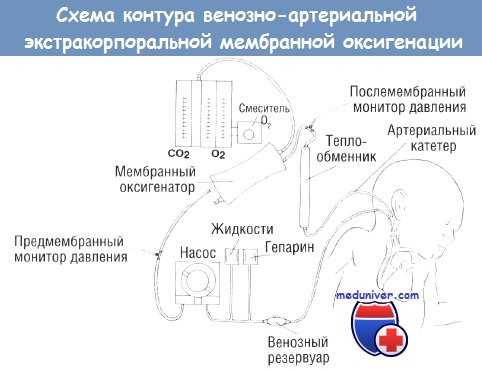 Схема контура экстракорпоральной мембранной оксигенации (ЭКМО)