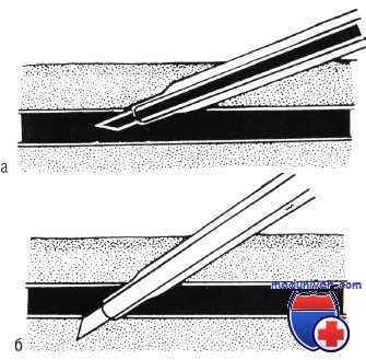 катетеризация периферической артерии у новорожденного
